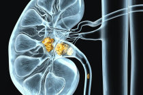 C&aacute;lculos renais em crian&ccedil;as: o que muda em rela&ccedil;&atilde;o aos adultos?